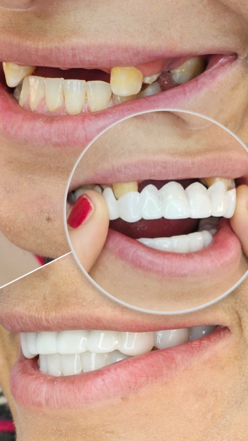 🦷¿Sueñas con una sonrisa blanca y perfecta? Este es tu momento.🦷